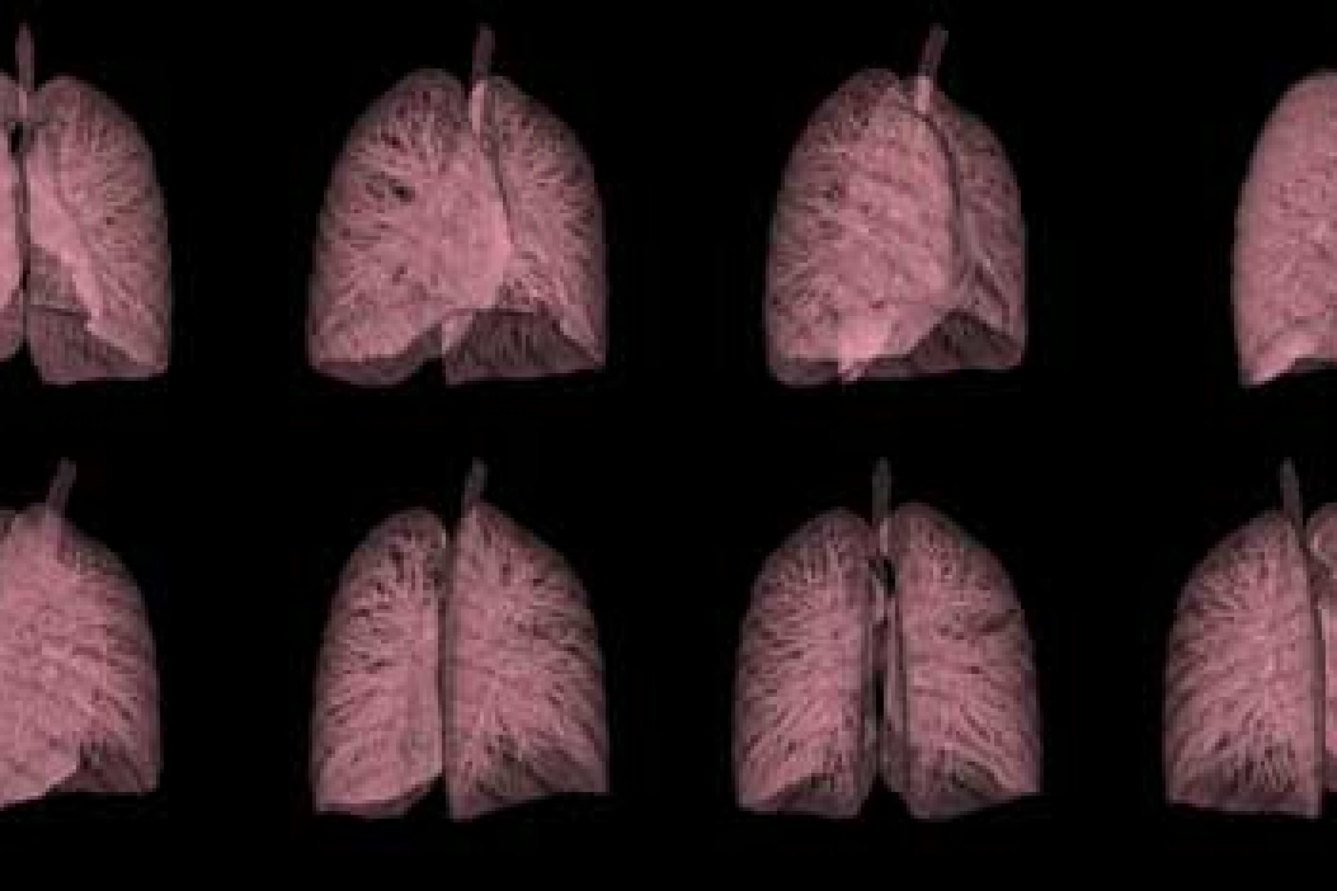 copd